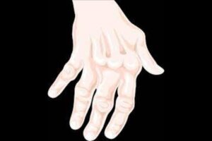 Bursitis: