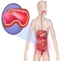 Causes of Crohn’s Ailment