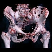 bone cancer
