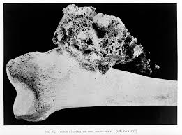 Osteosarcoma