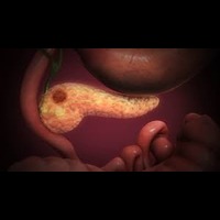 Pancreatic Cancer
