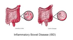 IBD, or inflammatory bowel illness,